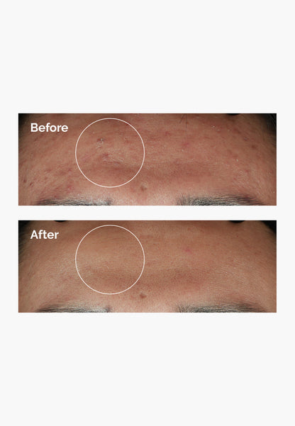 The Ordinary Niacinamide 10% + Zinc 1%